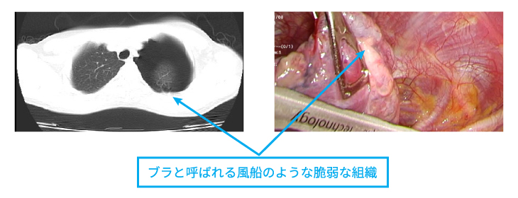 pneumothorax_center_img03.jpg